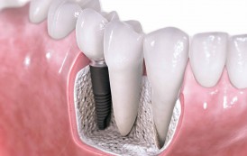 Mitos y Realidades De Los Implantes Dentales