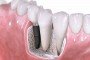 Mitos y Realidades De Los Implantes Dentales