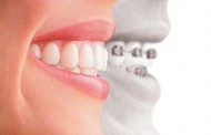 Higiene Oral Durante El Tratamiento De Ortodoncia