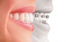 Higiene Oral Durante El Tratamiento De Ortodoncia