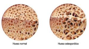 Vista de estructura osea sana y con osteoporosis