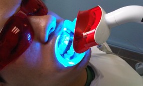 imagen de un blanqueado dental con lampara fotocurable