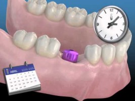Proceso de implante dental