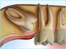 sinusitis maxilar