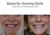anuncio de botox para sonrisa gingival