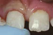 imagen de una reinsercion de diente 